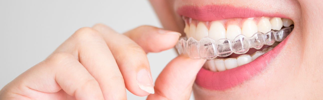 Benefits Of Invisalign