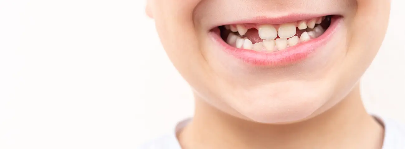 Spaces Between Teeth